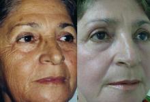 Миндальный пилинг лица: секреты бархатистой кожи по приемлемым ценам